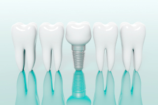 西鉄平尾駅・【松尾歯科クリニック】・インプラント